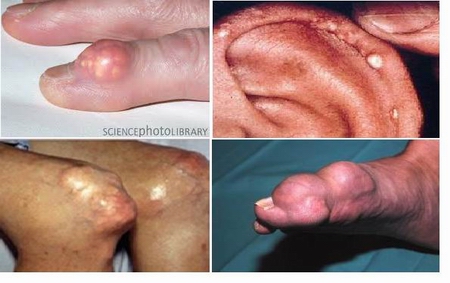 Các biến chứng của bệnh Gout có thể bao gồm khối u nhỏ hình thành dưới da (được gọi là tophi), gây tổn thương khớp, bệnh sỏi thận và cơn đau do Gout tấn công có thể ảnh hưởng cuộc sống hàng ngày của người bệnh.