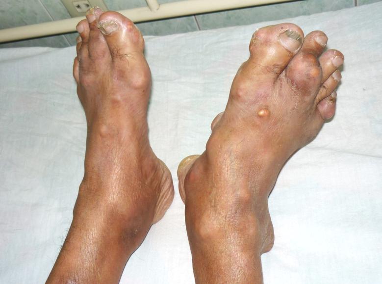 Gout là thể bệnh xuất hiện khi có sự rối loạn chuyển hóa purin trong cơ thể dẫn đến dư thừa lượng axit uric, và chúng lắng đọng thành các tinh thể muối urat sắc nhọn ở các khớp xương gây viêm nhiễm.
