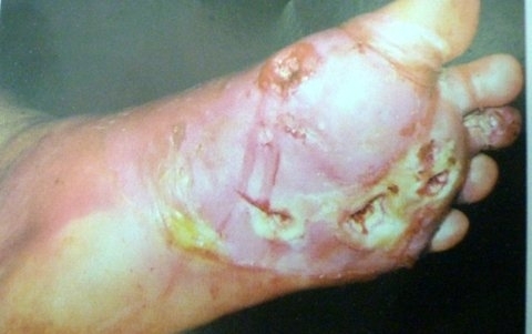Đây là lòng bàn chân của một bệnh nhân gout.