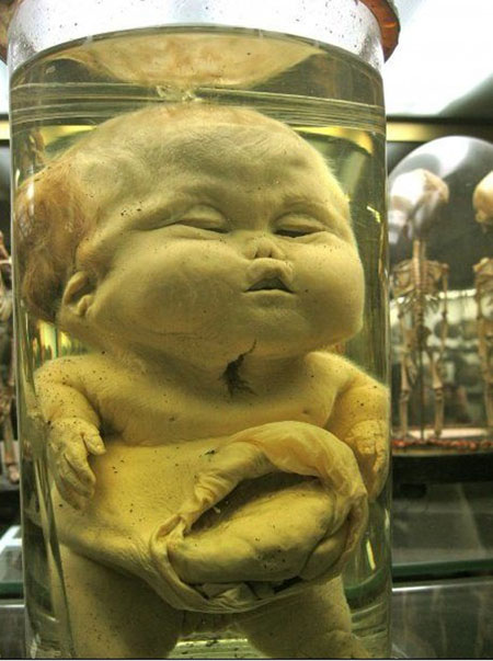 Bảo tàng Dupuytren tại Paris, Pháp trưng bày cơ quan trên cơ thể khác nhau của những em bé bị biến dạng. Nơi này thuộc về một nhà giải phẫu học nổi tiếng.