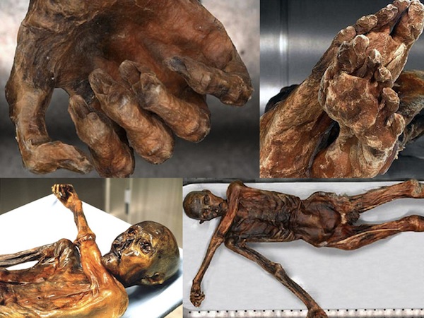 Người băng Otzi là một trong những xác ướp cổ với niên đại hơn 5000 năm và được bảo quản trong điều kiện cực tốt. Trên cơ thể của xác ướp có hơn 50 hình xăm thể hiện phòng và chữa lành bệnh.