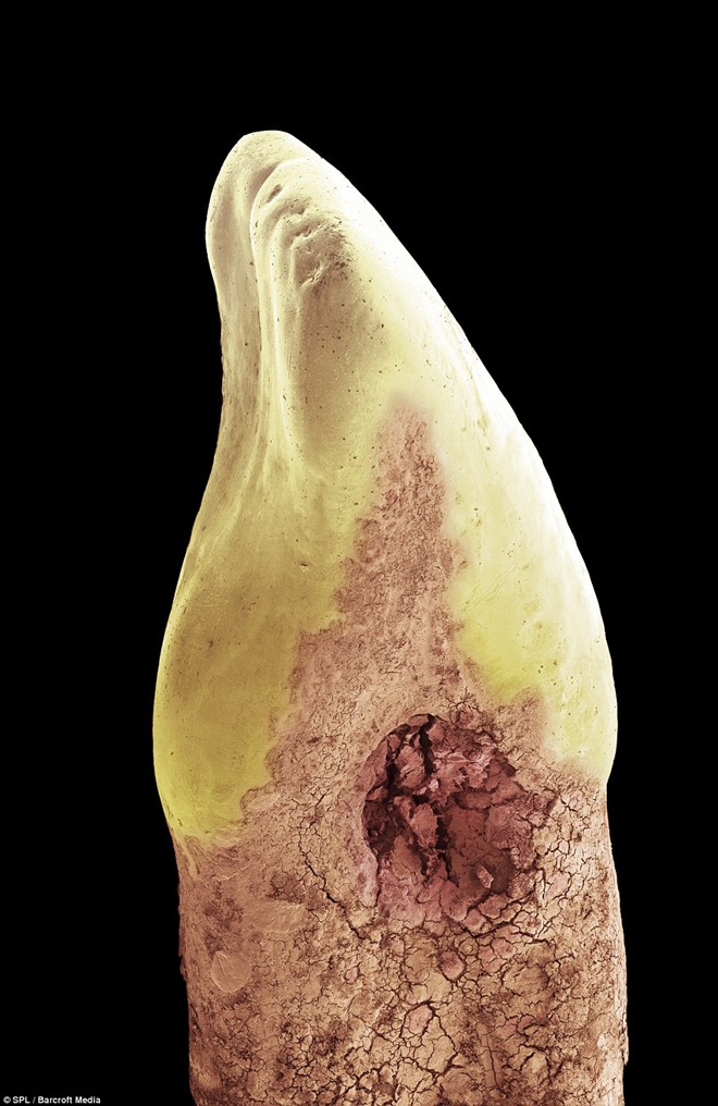 Hình ảnh trên bề mặt một chiếc răng vàng cho thấy một thảm xanh các vi khuẩn hình cầu và hồng cầu đang phát triển.