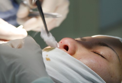 Bác sỹ cho bông vào mũi bệnh nhận để tránh chảy máu trong.