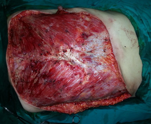 Bệnh nhân bị lòi xương vì bơm silicon nâng ngực.