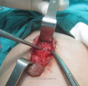 Những viên silicon bị đóng cục trong ngực các bác sỹ đang tiến hành mổ để lấy.
