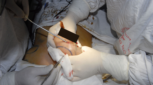 Các bác sỹ đang lấy silicon lỏng trong ngực bệnh nhân.