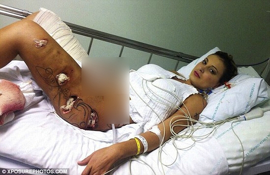 Siêu mẫu ngực 'khủng' Andressa Urach đang đứng trước nguy cơ mất chân do tác hại của chất độn vòng 3 trong cơ thể gây ra.