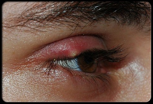 Lẹo là bệnh nhiễm khuẩn cấp có mủ không lan rộng của một hay nhiều tuyến zeis hay moll (lẹo phía ngoài); hoặc của các tuyến meibomius (lẹo trong mi mắt) do tụ cầu khuẩn gây nên.