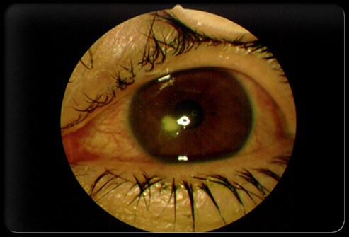 Viêm loét giác mạc (VLGM) là một bệnh rất nguy hiểm vì nó sẽ để lại những di chứng vĩnh viễn như sẹo giác mạc, teo nhãn, lồi mắt cua và làm mất một phần hoặc toàn bộ thị lực.