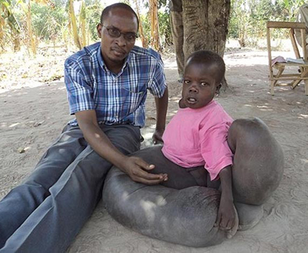 Cậu bé 10 tuổi người Uganda tên là Vincent Oketch gặp vấn đề về bạch huyết khiến đôi chân sưng to bất thường.