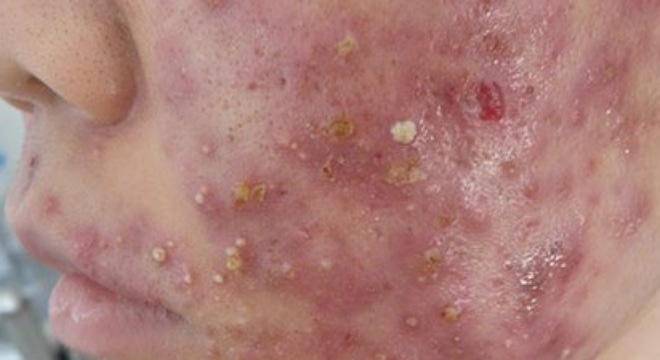 Mặt rất nhiều mụn mủ do vi khuẩn trong kem trắng da.