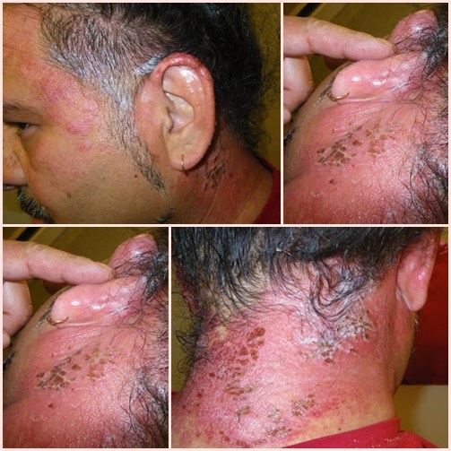 Thuốc nhuộm tóc còn gây ra nhưng hậu quả kinh hoàng hơn nhiều nếu da không chịu được các thành phần trong thuốc.