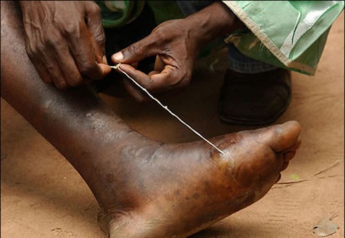 Bệnh Giun Guinea được ví như loài rồng lửa nhỏ ẩn nấp dưới lớp biểu bì và thiêu đốt da của người bệnh. Người nhiễm Guinea sẽ vô cùng đau đớn và phải nằm liệt giường trong thời gian dài.
