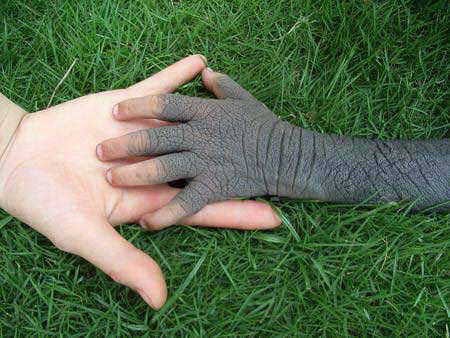 Da voi - trường hợp em bé 4 tuổi trong hình, cơ thể đang trong giai đoạn phát triển thì xuất hiện những triệu chứng này trên bàn tay.
