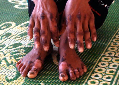 Viêm da dày sừng bàn tay, bàn chân - đây là căn bệnh chưa từng xuất hiện trên thế giới.