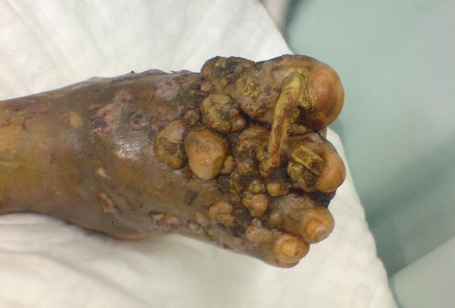 Bệnh chân Madura là một bệnh nhiễm nấm các mô và xương chân. Vi khuẩn gây bệnh xâm nhập vào cơ thể qua các vết thương hở khi làm việc trong môi trường đất bẩn như cánh đồng.