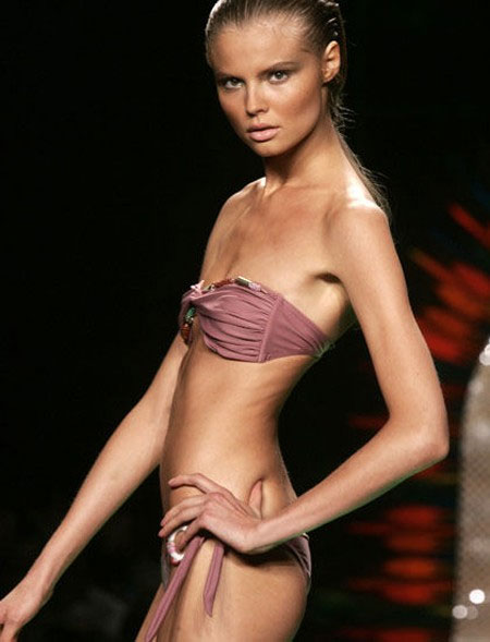 Đây là hình ảnh của một cô người mẫu vì giảm cân  quá đà khiến người gầy trơ xương.
