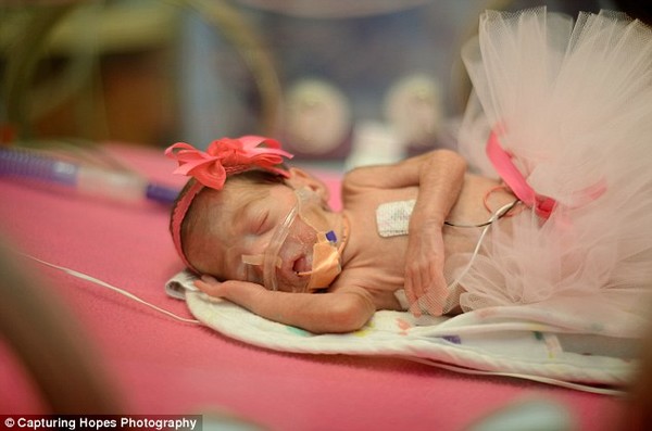 Bé Hayley chào đời khi mới được 27 tuần tuổi 4 ngày do mẹ bé bị tiền sản giật, Hayley chỉ nặng 0,6 kg.
