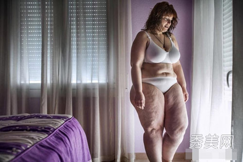 Một bệnh nhân có tên Sandra, 31 tuổi sống ở Tây Ban Nha nặng 124 kg rất đau khổ về căn bệnh béo phì và quyết định thực hiện theo phương pháp giảm cân là cắt bỏ dạ dày.