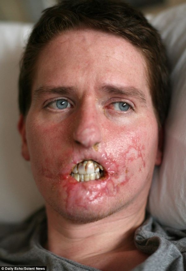 Hình ảnh người đàn ông sau khi bị vi khuẩn ăn thịt người tấn công.