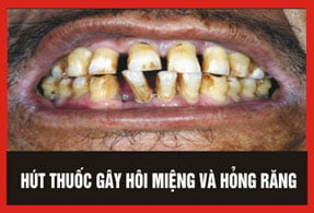 Hút thuốc lá làm hỏng vẻ ngoài của bạn bằng cách mang đến cho bạn một hàm răng vàng và xỉn.