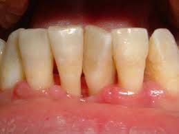 Hút thuốc cũng làm chậm lại quá trình liền vết thương sau nhổ răng hoặc phẫu thuật khác trong miệng.