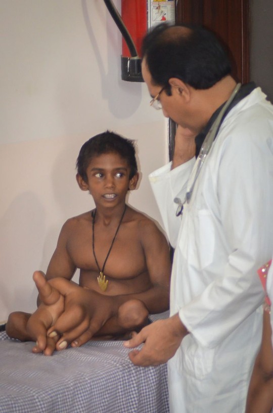 Bác sĩ Ratan, giám đốc bệnh viện nơi gia đình Kaleem sống nói: 'Theo hiểu biết của tôi, đây là một bệnh cực hiếm. Tôi chưa từng thấy trường hợp nào có bàn tay lớn như vậy...'