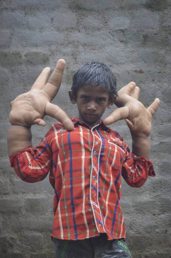 Cậu bé Kaleem (8 tuổi, ở Ấn Độ) đang là người có đôi bàn tay lớn nhất thế giới.