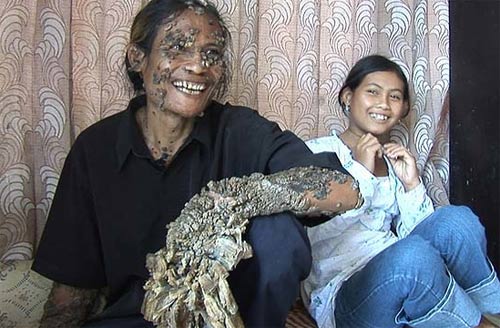 Ngoài những bức ảnh được nhiếp ảnh gia ghép, dưới đây là hình ảnh của 'người cây' có thực ngoài đời. Đây là anh Dede sống tại thủ đô Jakarta của Indonesia với cơ thể mọc thành cây vì căn bệnh lạ.