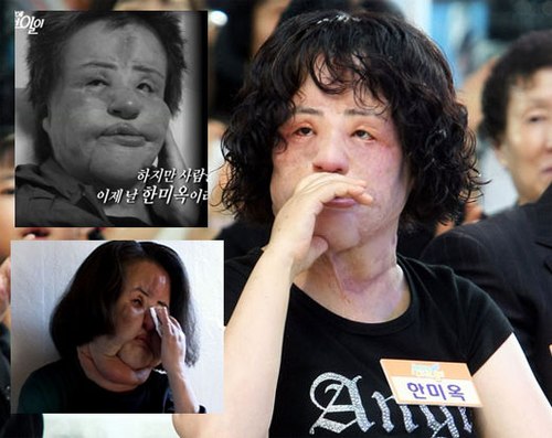 Han Min Ok từng không dám ra đường vì khuôn mặt phẫu thuật hỏng.