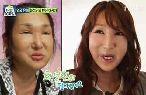 Khuôn mặt của cô đã thay đổi rất nhiều sau khi được tài trợ phẫu thuật lại.