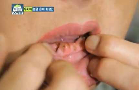 Hàm răng rụng của Yang.