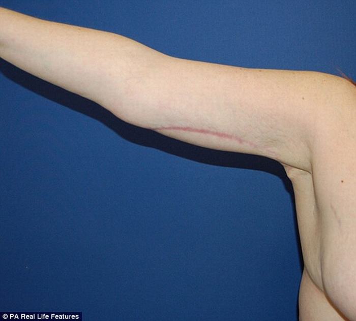 Sau khi phẫu thuật, vùng da thừa ở bụng, đùi và bọng cánh tay được loại bỏ hoàn toàn.