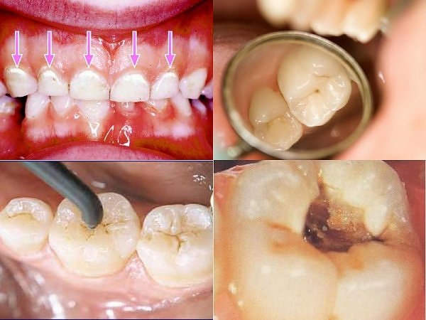 Sâu răng, chậm mọc răng canxi cũng là một thành phần quan trọng của răng. Do dó, thiếu hụt canxi trong cơ thể cũng ảnh hưởng đến răng, gây sâu răng. Trẻ em thiếu canxi có thể mọc răng trễ hơn so với các bé cùng tuổi.