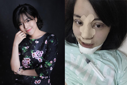 Đào Minh Châu (sinh năm 1993) thu hút sự quan tâm của dân mạng vì xinh đẹp rạng ngời sau khi phẫu thuật thẩm mỹ thành công.