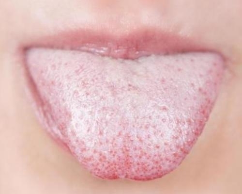 Lưỡi trắng - nếu lưỡi bạn xuất hiện bợn trắng trên lưỡi cũng có thể là một dấu hiệu cho thấy có quá nhiều độc tố trong cơ thể.