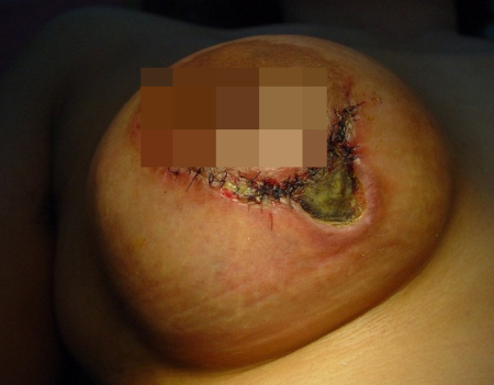 Vết khâu xấu xí sau khi phẫu thuật bầu ngực.