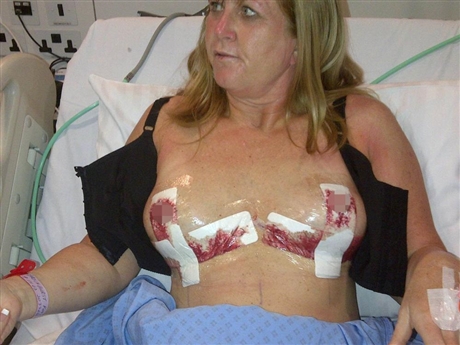 Bà Kim Brockhurst, 51 tuổi, là một huấn luyện viên dạy thể hình tại Ebbw, miền nam xứ Wales, Anh Quốc đã bị nổ ngực do bơm quá nhiều silicon.