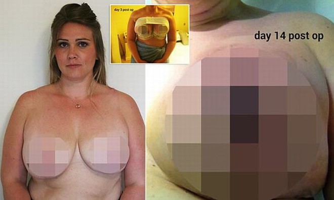 Laura Damiani (quản lý nhà hàng), 31 tuổi tại Anh bị hoại tử ngực và phải cắt bỏ núm vú.
