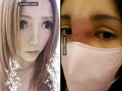 Các diễn đàn mạng đang xôn xao với hình ảnh biến chứng của cô gái trẻ Trung Quốc sau phẫu thuật thẩm mỹ mũi.