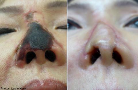 Cô Jenny – 58 tuổi, sống tại Singapore bị hoại tử hết phần mũi.