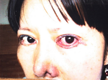 Phần mí mắt bên dưới bị cắt hoàn toàn khiến thị lực giảm đi đáng kể, mắt sưng đỏ trong nhiều ngày.