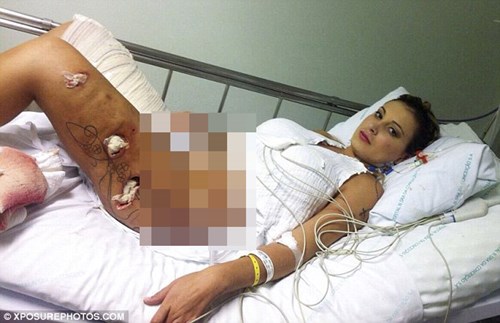 Andressa Urach, á hậu trong một cuộc thi sắc đẹp tại Brazil đã phải nhập việt sau một cuộc phẫu thuật thẩm bơm vùng đùi và hông bị hỏng.