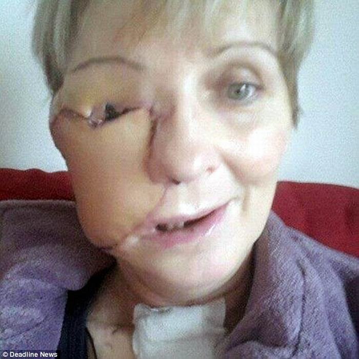 Lúc này, mắt của Helen đã bị khối ung thư tàn phá nên các bác sỹ phải tiến hành đồng thời ca phẫu thuật loại bỏ mắt phải trong vòng 22 giờ đồng hồ tại Bệnh viện đa khoa Nam Glasgow.
