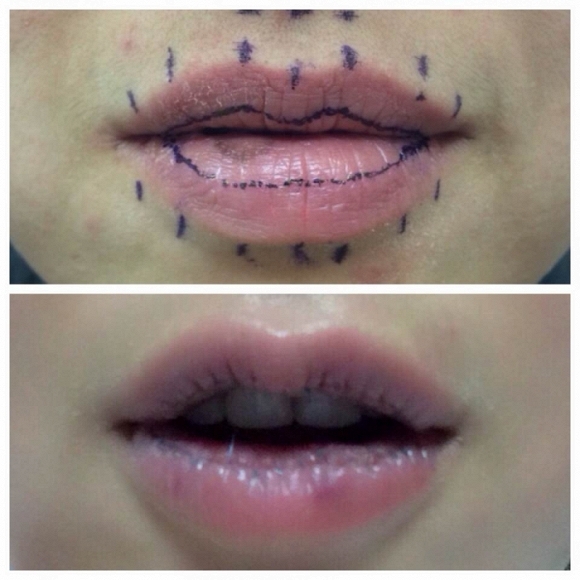 Đôi môi trước và sau khi phẫu thuật của cô.