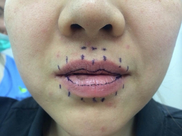 Một cô gái Thái Lan giấu tên đã đăng tải lên bức hình cắt bỏ phần môi của mình.