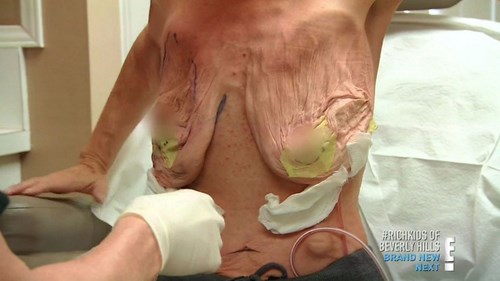 Bộ ngực khủng của bà Stein, được cấy ghép từ 20 năm trước, chứa hai miếng độn to, làm bằng silicone và có chứa muối saline.