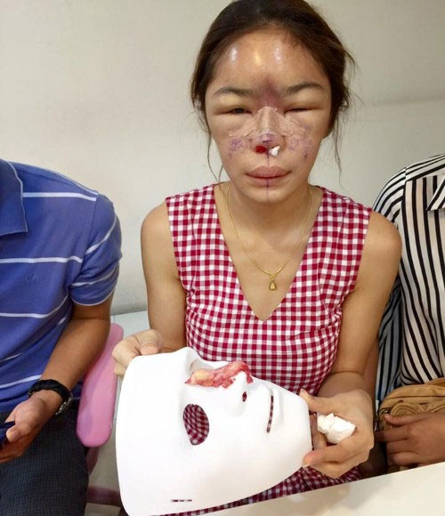 Mới đây, một cô gái xinh đẹp ở Thái Lan đã công khai những hình ảnh chụp chiếc mũi hỏng do biến chứng phẫu thuật thẩm mỹ của mình.