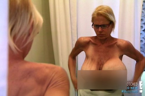 Một phụ nữ 53 tuổi tên là Dee Stein đã xuất hiện trên chương trình truyền hình thực tế về phẫu thuật thẩm mỹ Botched để thực hiện ca phẫu thuật sửa lại bộ ngực nhân tạo bị hỏng nặng của mình.