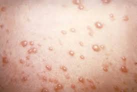 Sần - những nốt nhỏ nhô lên trên da có thể là triệu chứng của bệnh u mềm lây. Mụn đỏ nhỏ cũng có thể xuất hiện trong bệnh nhiễm virus herpes lây qua đường tình dục.